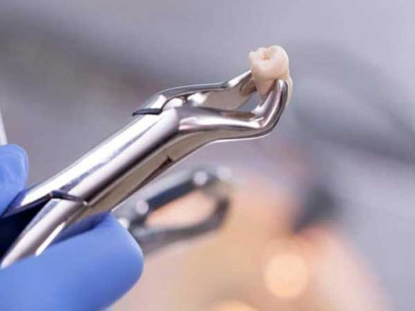 Chàng trai 26 tuổi chết vì xuất huyết não sau khi nhổ răng khôn, cảnh báo những lưu ý khi nhổ răng khôn