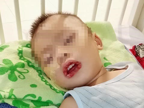 Bé trai 21 tháng tuổi loét thực quản, dạ dày vì uống nhầm chất tẩy bồn cầu