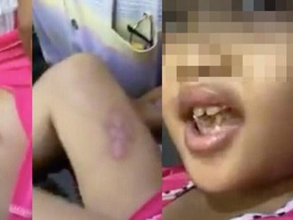 Bé gái 7 tuổi bị người tình của mẹ bạo hành dã man, dùng tàn thuốc châm vào ngực vì “ngủ rồi tiểu trên nệm”