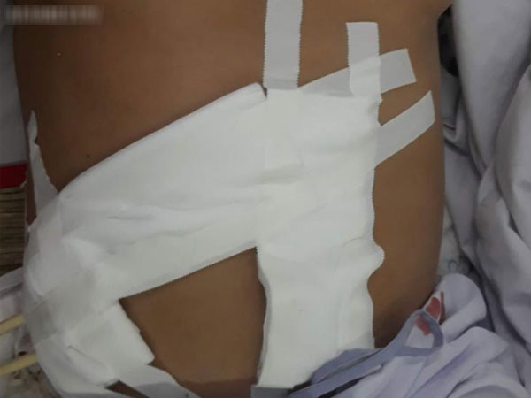 Bị tăng huyết áp và có ngực to như phụ nữ, người đàn ông suýt chết vì khối u lớn 'khủng' ở thận