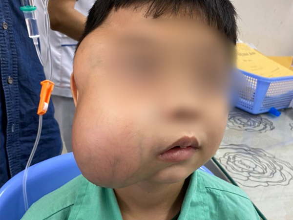 Bé trai 13 tuổi mang khối u xơ vòm họng 'khổng lồ' lần đầu tiên ghi nhận tại Việt Nam