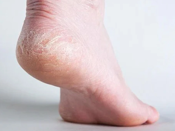 Luôn cảm thấy gót chân bị khô và nứt nẻ: 4 'thủ phạm' là nguyên nhân gây ra vấn đề này nhưng nhiều người không biết