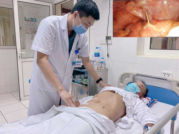 Nuốt phải tăm, người đàn ông bị đâm thủng ruột