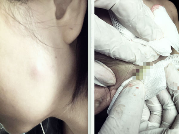 Tiêm botox làm thon gọn mặt, người phụ nữ 30 tuổi phải nhập viện