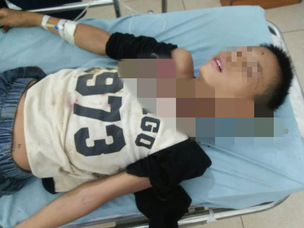 Trèo cây ngã, bé trai 12 tuổi bị cành cây đâm xuyên cổ