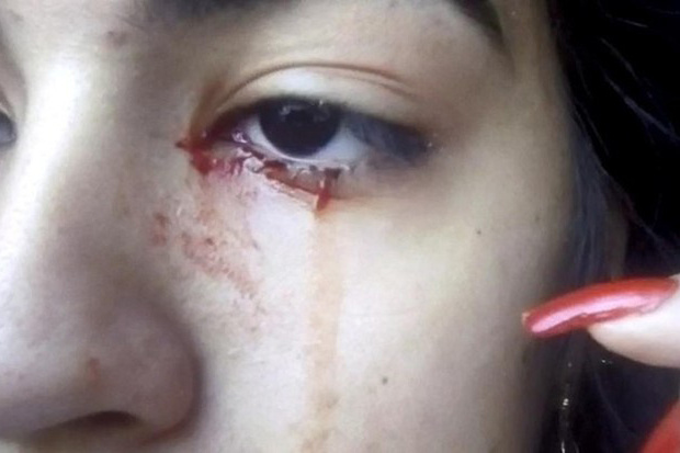 Các bác sĩ 'bó tay' vì một cô gái khóc ra máu