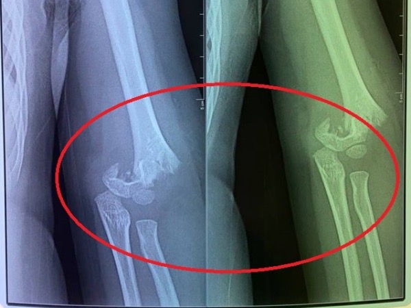 Bé gái 5 tuổi đi mẫu giáo bị bạn đẩy ngã gẫy tay nhưng cô giáo không đưa đi cấp cứu ngay, người mẹ chia sẻ: Nhà trường bặt vô âm tín!