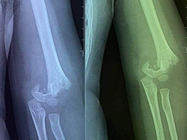 Hà Nội yêu cầu xác minh vụ trẻ mầm non bị ngã gãy tay tại trường