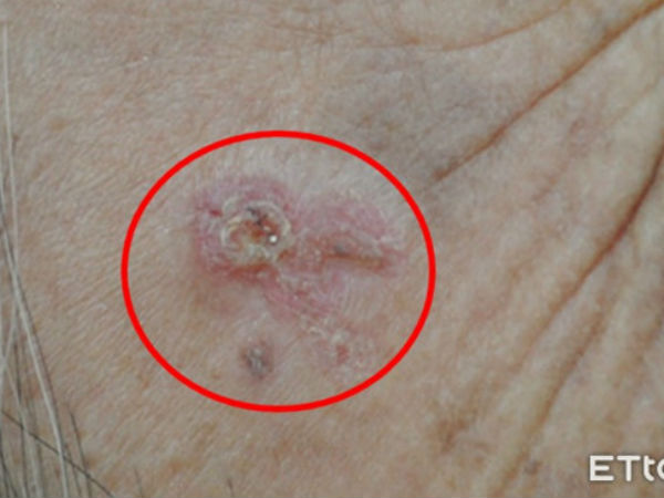 Chủ quan với vết ban đỏ trên trán, người phụ nữ không ngờ đó là dấu hiệu bệnh ung thư