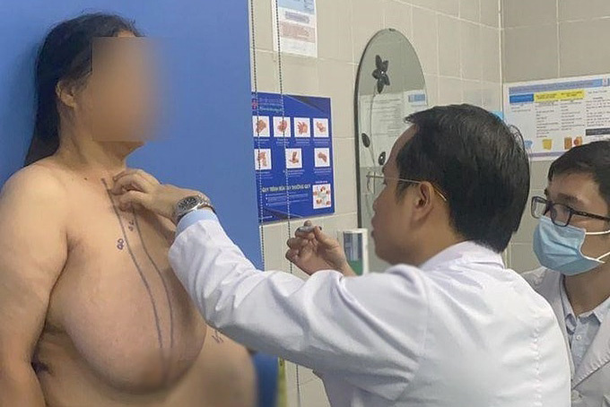 Người phụ nữ 28 năm chịu đựng bộ ngực khổng lồ