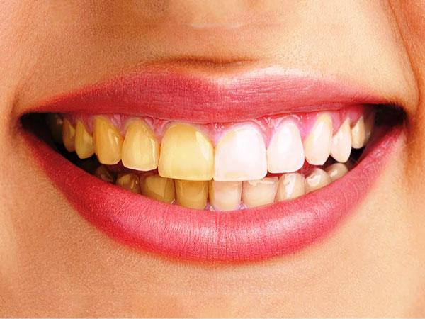 Vì sao răng bị ố vàng?