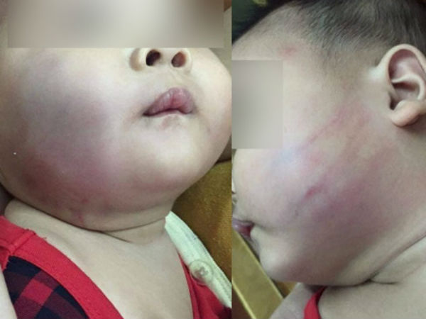 Xôn xao vụ việc bé trai 8 tháng tuổi đi nhà trẻ về bầm tím một bên má, mẹ vừa trông thấy mặt con liền ngất xỉu ngay tại chỗ
