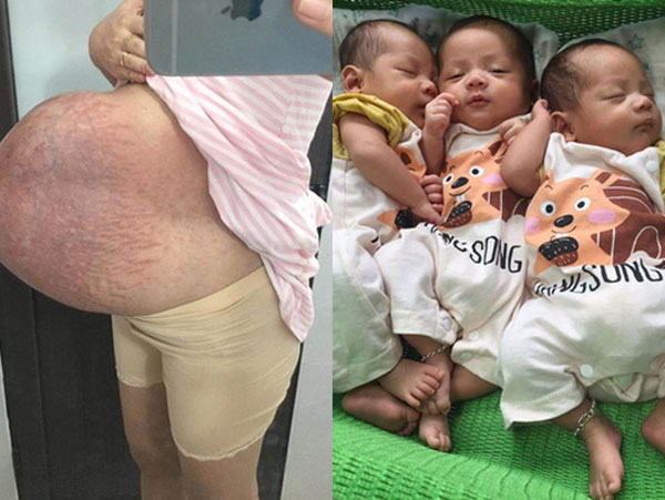 Cô gái trẻ sinh 3 con trai với chiếc bụng rạn 'nổi tiếng': Nỗi lo cơm áo và những điều vượt quá tưởng tượng