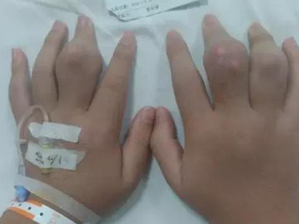 2 ngày 1 cốc trà sữa, hai bàn tay của chàng trai 18 tuổi nổi nhiều cục u to như hạt đào
