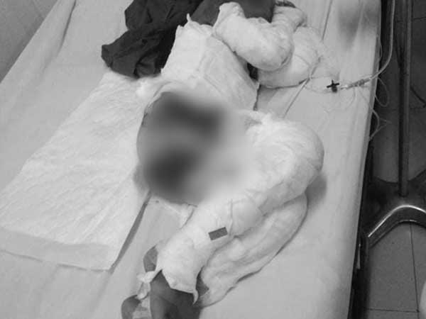 Thương tâm: Đang ăn cơm, bé gái lớp 2 biến thành 'ngọn đuốc sống' do xăng dầu bố mẹ trữ trong nhà đổ vào bếp bùng cháy