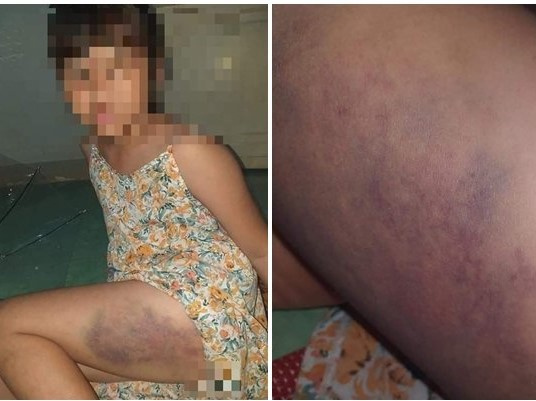 Xử phạt hành chính cô giáo đánh bầm tím đùi bé gái lớp 3