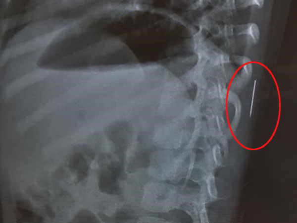 Bé gái 3 tuổi bị sốt cao liên tục, được đưa đi khám thì phát hiện chiếc kim khâu dài 17mm trong cột sống