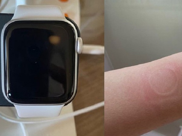 Apple Watch SE gặp lỗi quá nhiệt, khiến người dùng bị bỏng và làm hỏng màn hình