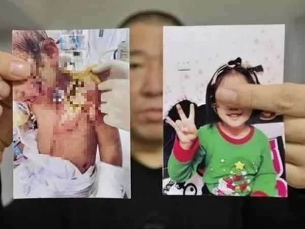 Bé 6 tuổi bị mẹ và bạn trai dội nước nóng, dùng kìm bẻ răng