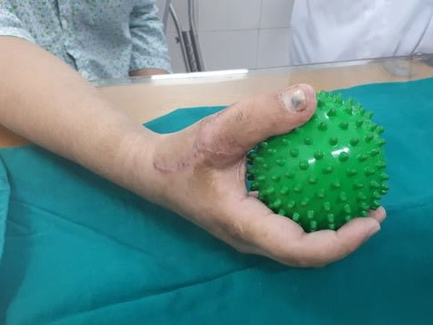 Phẫu thuật chuyển ngón chân thành ngón tay cho nam thanh niên 17 tuổi