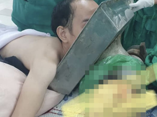 Tai nạn kinh hoàng: Chàng trai 27 tuổi bị máy xay thịt cuốn cả cánh tay đến sát vai, mặt bị kéo vào mâm inox, tình trạng nguy kịch