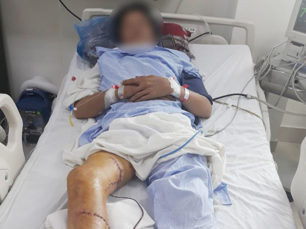 Tai nạn kinh hoàng: Người đàn ông bị máy cưa cắt thẳng vào đùi và cẳng chân mất máu nặng, tình trạng nguy kịch