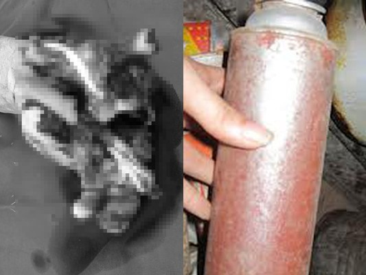 Nổ bình gas mini, người đàn ông mất cả bàn tay phải
