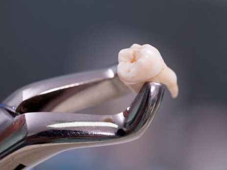 Nhổ 20 chiếc răng cùng lúc, người phụ nữ hôn mê trong 9 ngày rồi tử vong