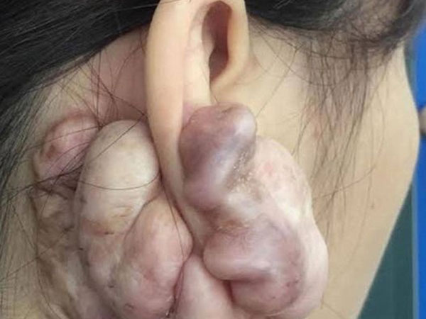 Hình ảnh sẹo đùn kín tai 'do nâng mũi bằng sụn tai' gây sốc trên MXH: Có hay không việc sửa mũi đẹp xong khiến tai bị dị dạng?
