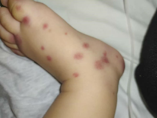 Tưởng vết ban đơn thuần, ai ngờ mắc bệnh cực hiếm Việt Nam chưa ghi nhận