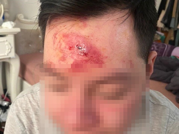 Mời rượu không uống, nhân viên quán bar xông vào đánh khách rách trán