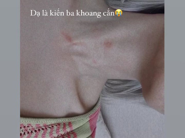 Cổ Châu Bùi xuất hiện vết lạ, sợ dân mạng nghĩ là hickey giống Ngọc Trinh hay sao mà vội thanh minh thế này