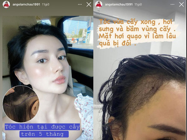 Hiện tượng dao kéo Việt tiết lộ đã cấy 2.000 sợi tóc, nối dài danh sách tu sửa để mãi đẹp