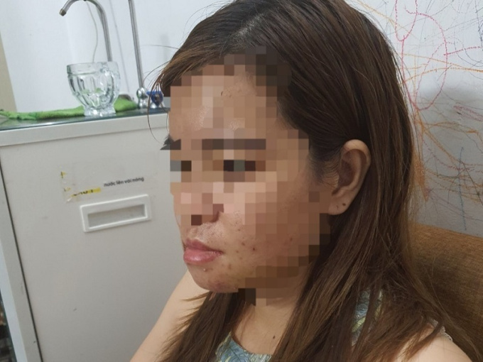 Người phụ nữ bị đánh hội đồng gãy quai hàm ngay tại nhà ở Bình Dương