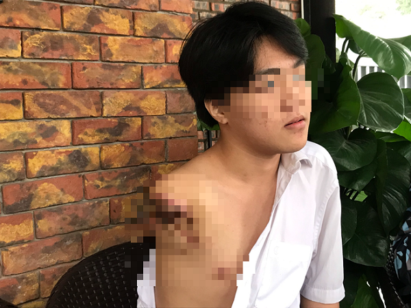 Nam sinh 16 tuổi bị máy tiện cuốn đứt lìa cánh tay trong giờ học thực hành