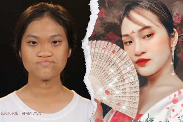 Từng nghĩ đến cái chết vì dị tật sứt môi, hở hàm ếch, nữ sinh Phú Thọ mạnh mẽ trải qua 6 lần dao kéo và có màn lột xác vô cùng đỉnh cao