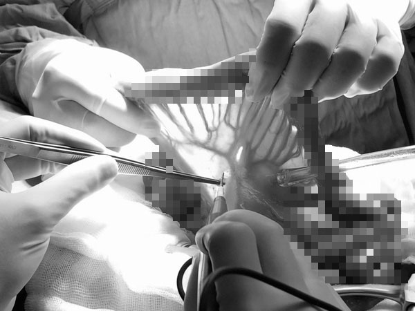 1 tháng nuốt vướng, ho đờm, người đàn ông phát hiện ung thư giai đoạn cuối