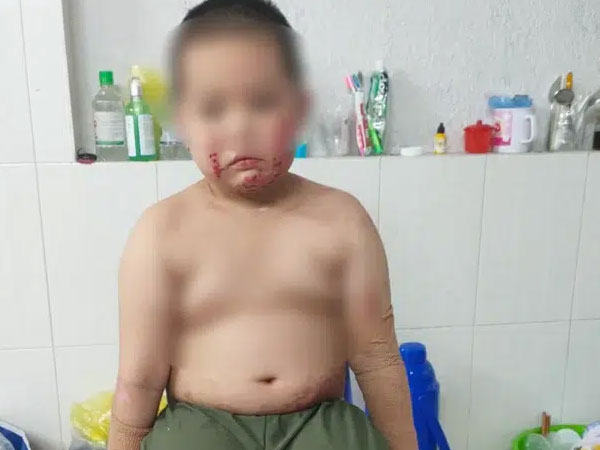 Vụ cha đóng cửa nhà châm lửa đốt khiến 2 con bỏng nặng, bản thân tử vong tại TP.HCM: Người mẹ bị sốc tâm lý, lúc tỉnh lúc mê