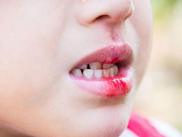 4 triệu chứng điển hình thường xuất hiện trong giai đoạn đầu của bệnh ung thư miệng