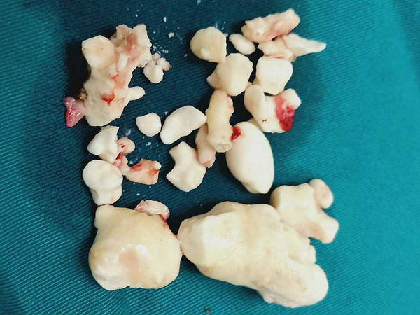 Hà Nội: Nghiện rượu từ cấp 3, người đàn ông có hơn 20 viên sỏi trong tụy