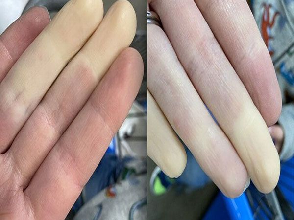 Bệnh mùa lạnh ngón tay trắng bệch