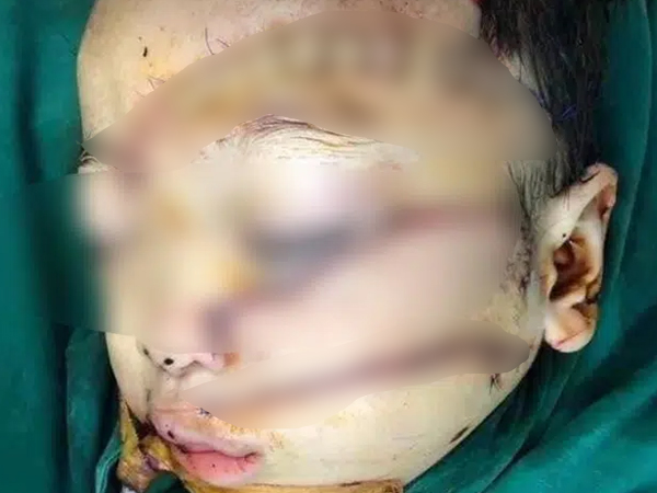 Kinh hoàng: Mẹ bỏ đi được 4 tháng, con trai 5 tuổi bị cha chém nát mặt, khâu 300 mũi