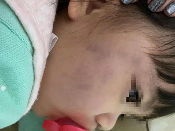 Thấy con gái thâm tím hai má, mẹ sốc nặng khi biết giúp việc bạo hành kèm theo lời chửi rủa: 'Không ngủ à? Tao đánh chết mày!'