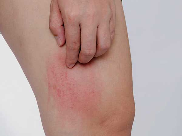 Ngứa 'như điên', tưởng ung thư hoá ra vì... hanh, lạnh