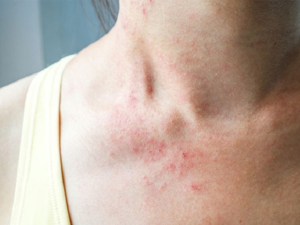 Mùa đông ngứa người như kim đâm, đầu đầy gầu: Không phải do bạn ở bẩn mà chính là do cách tắm của bạn