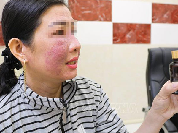 Nhiều chị em bị tai biến do làm trắng da cấp tốc đón Tết