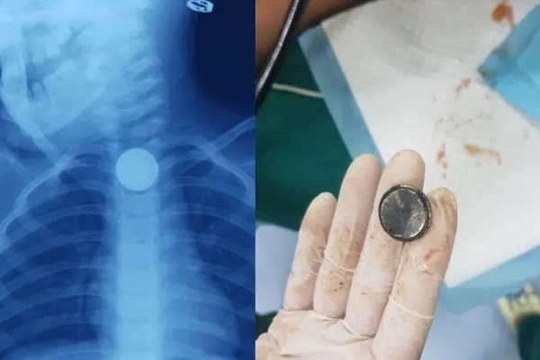Thực quản của đứa trẻ 2 tuổi bị cháy đen, phải mổ cấp cứu vì ăn phải thứ này