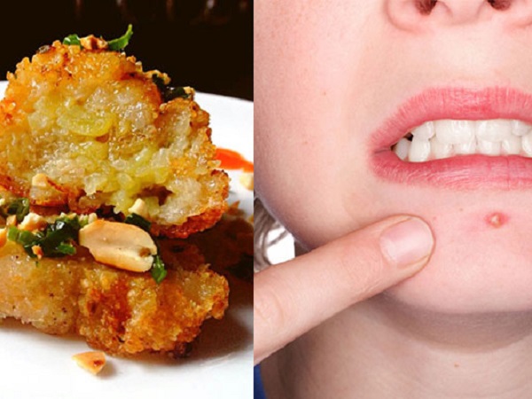Tết muốn ăn bánh chưng nhưng lại không muốn mọc mụn: Nằm lòng ngay bí quyết sau