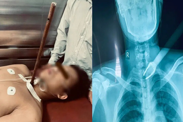 Kinh hoàng: Nam sinh Đại học Cần Thơ bị trộm chó bắn tên xuyên cổ