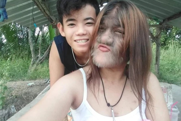 Cô bé 'người sói' từng nổi tiếng thế giới vì toàn thân phủ đầy lông gây bất ngờ với diện mạo hiện tại và cuộc sống hạnh phúc bên bạn trai